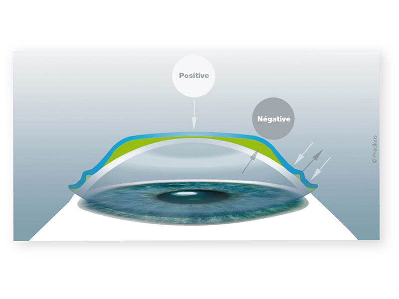 01_Geometrie_Adaptation_Orthokeratologie_fillesdyeux_centre_ophtalmologie_Tournai